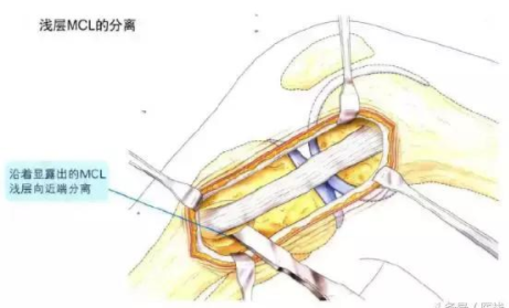 侧副韧带重建康复