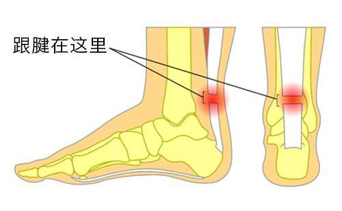 跟腱断裂缝合术后康复